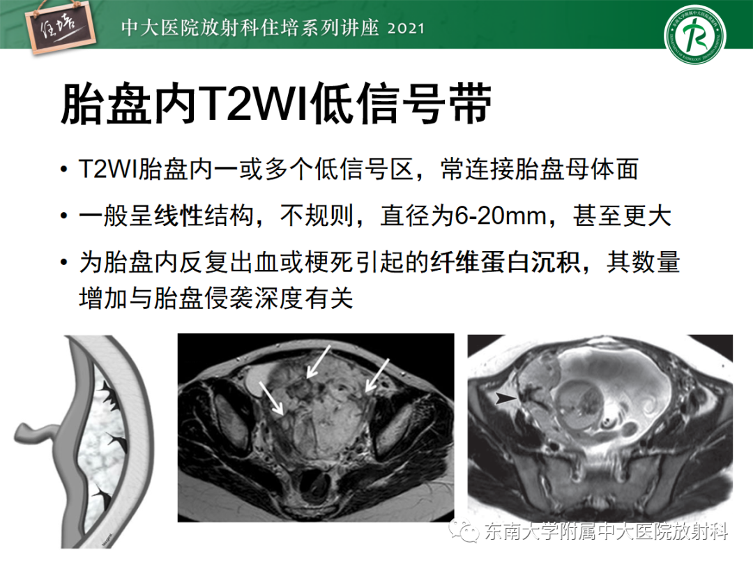 影像PPT - 【PPT】胎盘变异与胎盘植入性疾病的MR评估-23