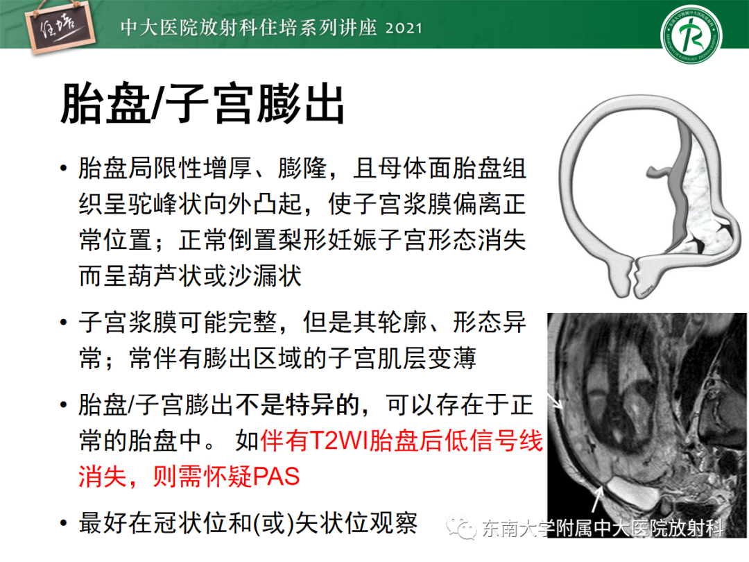 影像PPT - 【PPT】胎盘变异与胎盘植入性疾病的MR评估-25