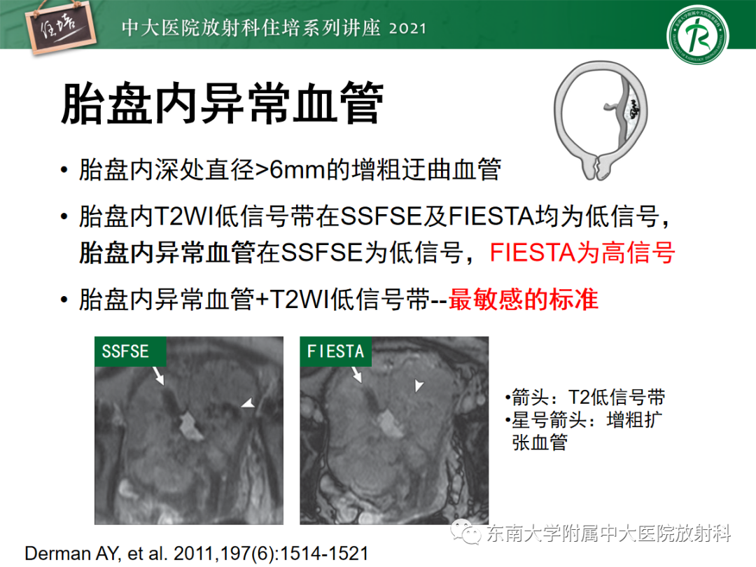 影像PPT - 【PPT】胎盘变异与胎盘植入性疾病的MR评估-24