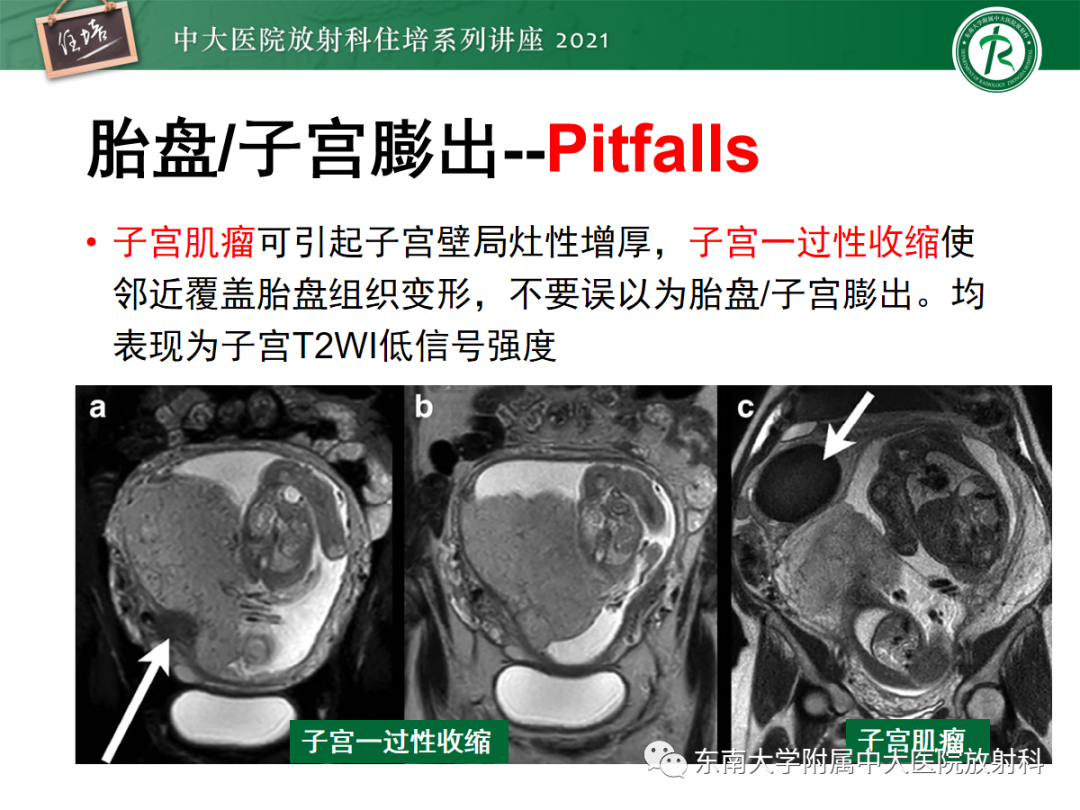 影像PPT - 【PPT】胎盘变异与胎盘植入性疾病的MR评估-26