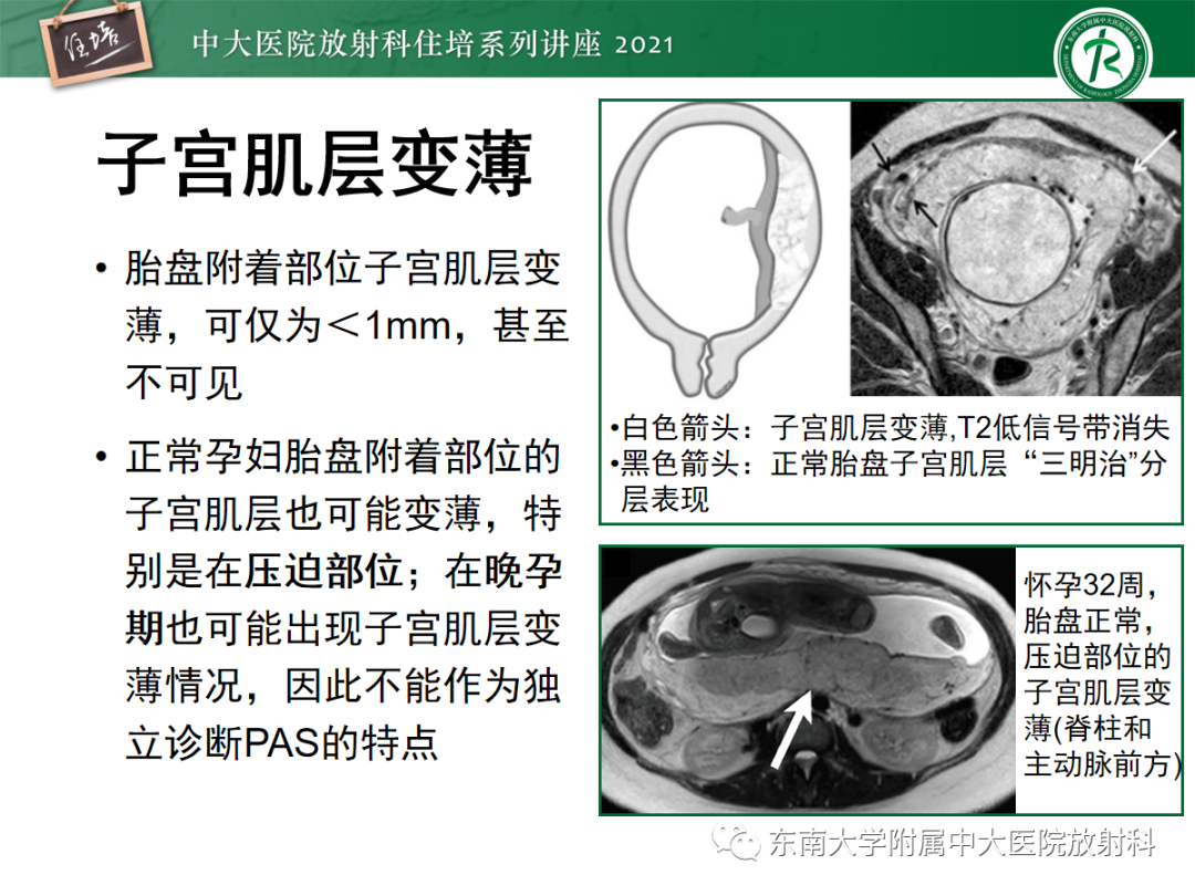 影像PPT - 【PPT】胎盘变异与胎盘植入性疾病的MR评估-28
