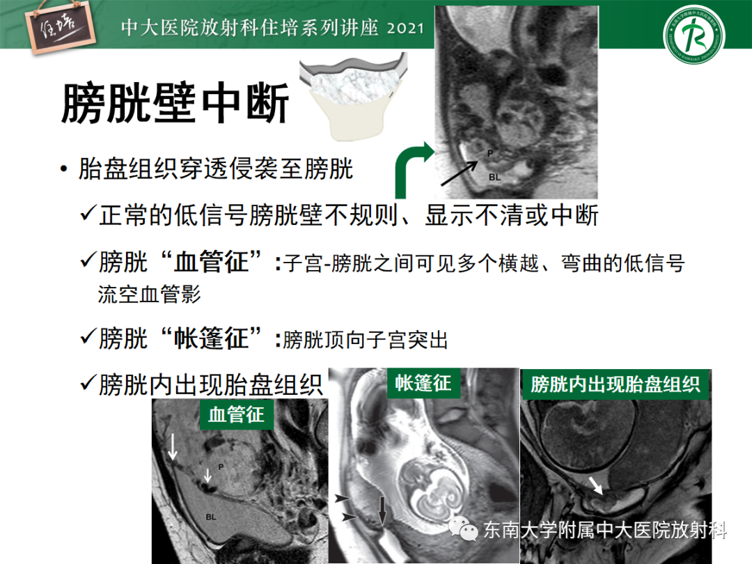 影像PPT - 【PPT】胎盘变异与胎盘植入性疾病的MR评估-29