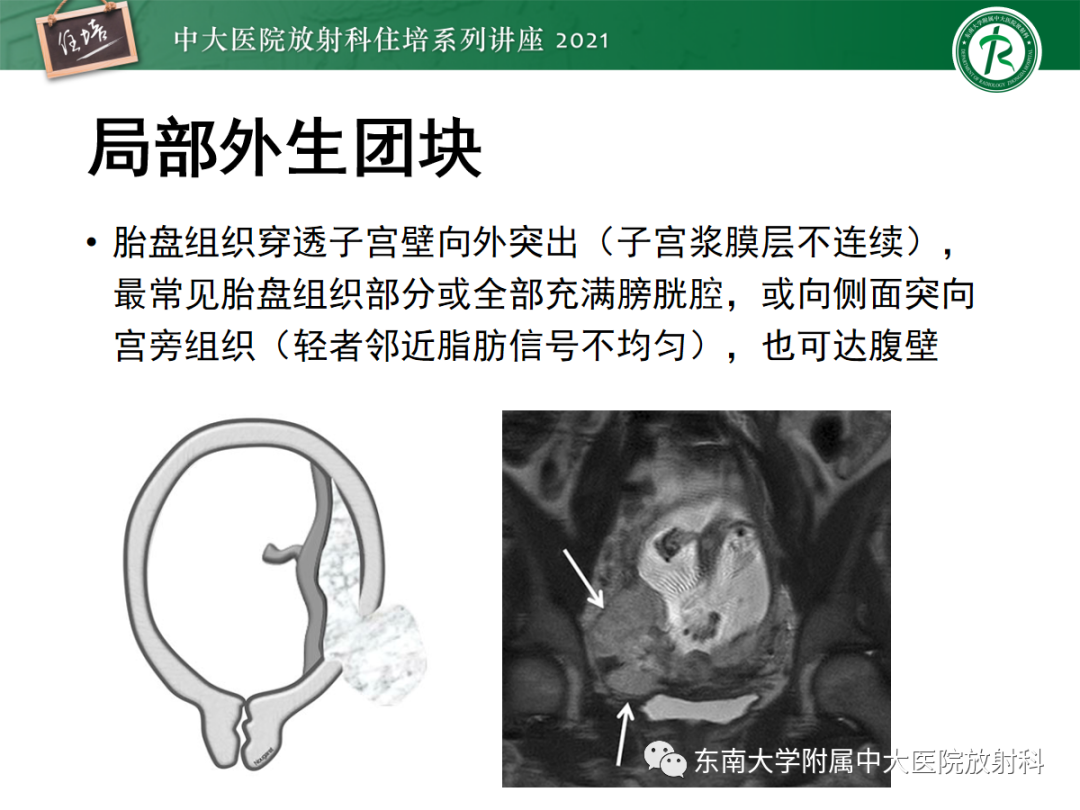 影像PPT - 【PPT】胎盘变异与胎盘植入性疾病的MR评估-30