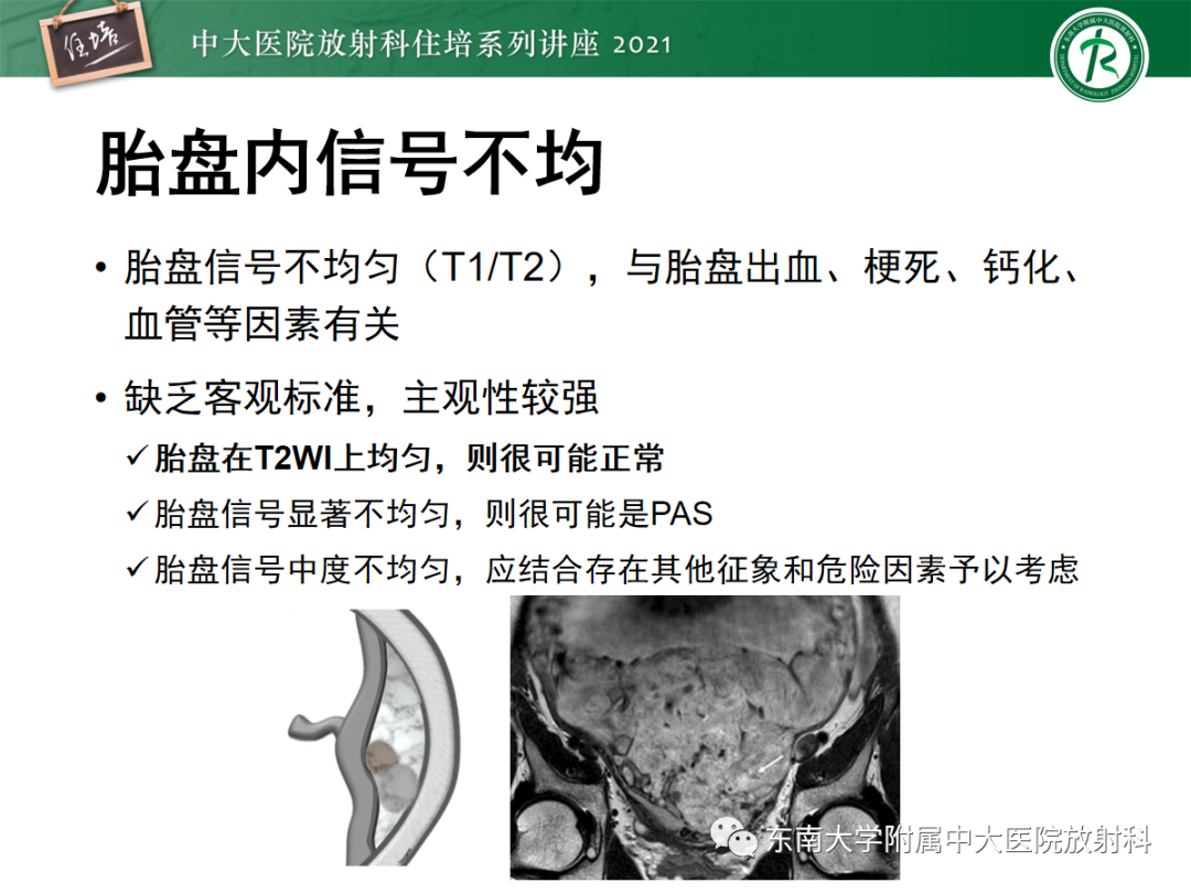 影像PPT - 【PPT】胎盘变异与胎盘植入性疾病的MR评估-32