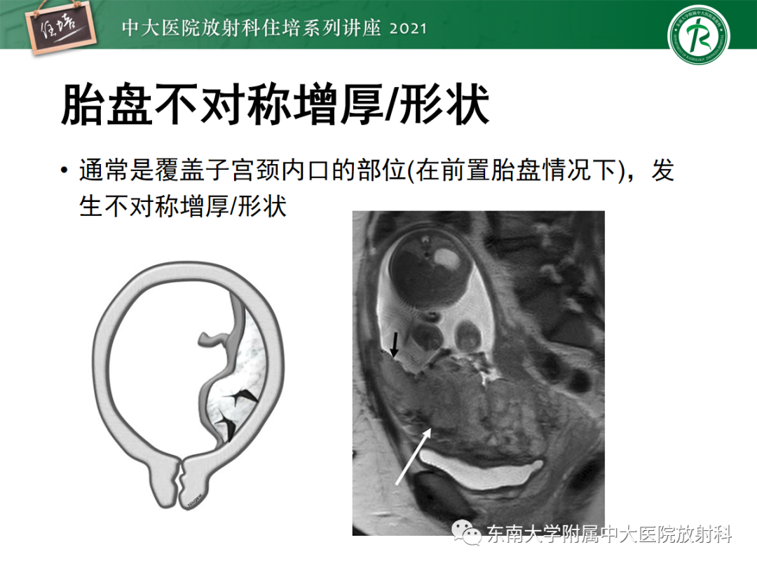 影像PPT - 【PPT】胎盘变异与胎盘植入性疾病的MR评估-34