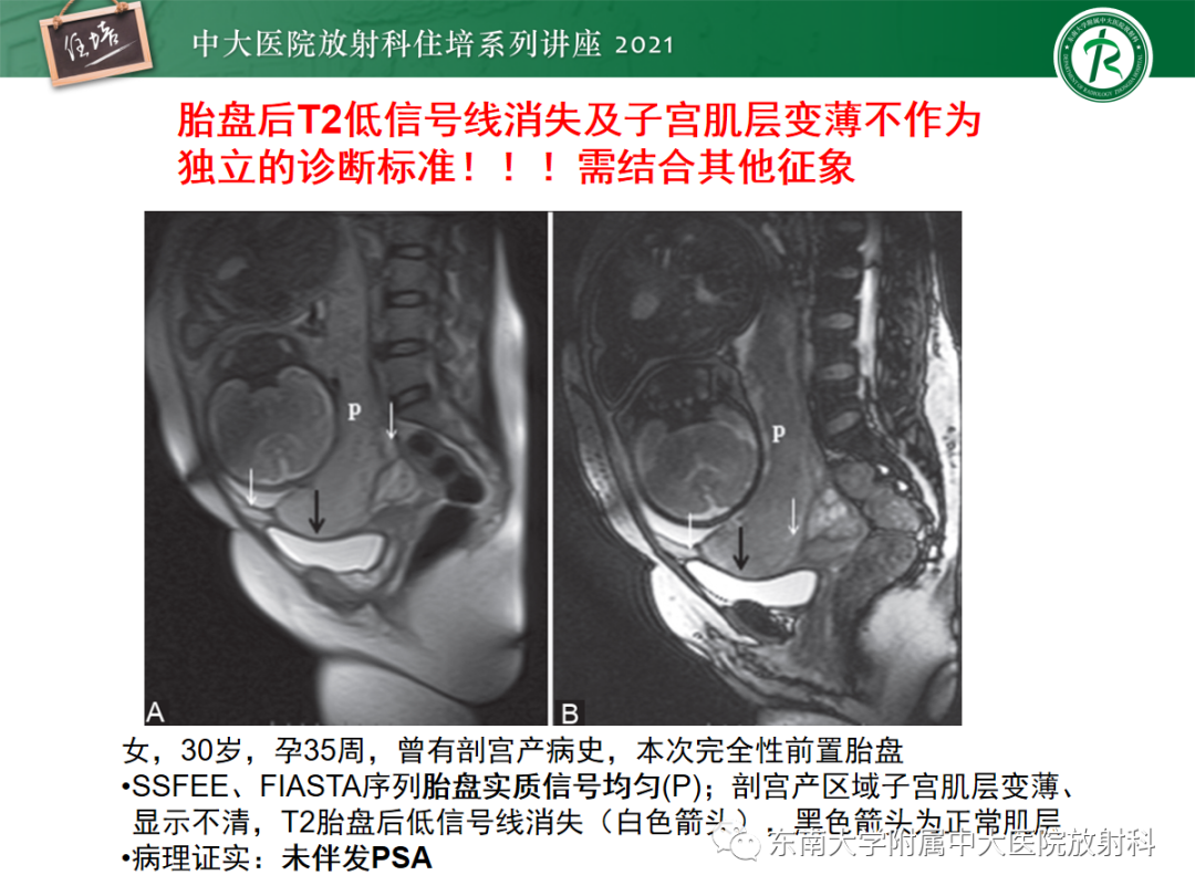 影像PPT - 【PPT】胎盘变异与胎盘植入性疾病的MR评估-33