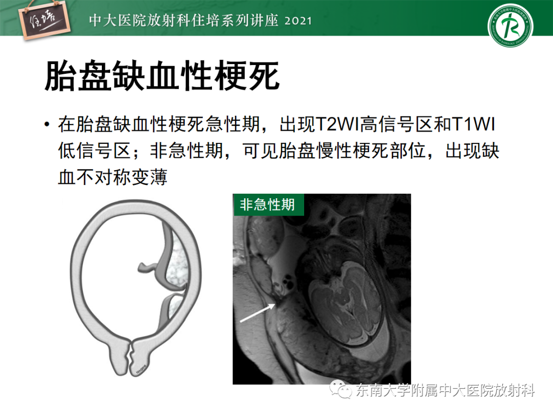 影像PPT - 【PPT】胎盘变异与胎盘植入性疾病的MR评估-35