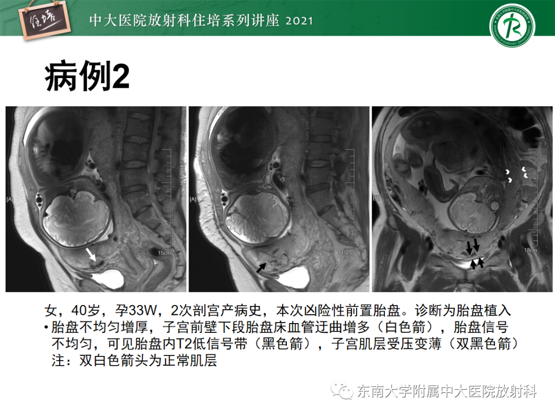 影像PPT - 【PPT】胎盘变异与胎盘植入性疾病的MR评估-40