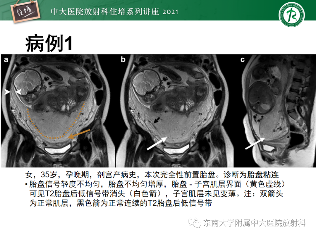影像PPT - 【PPT】胎盘变异与胎盘植入性疾病的MR评估-39