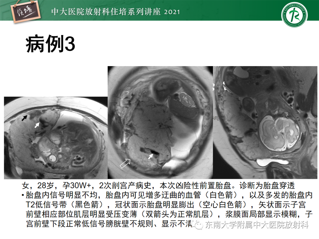 影像PPT - 【PPT】胎盘变异与胎盘植入性疾病的MR评估-41