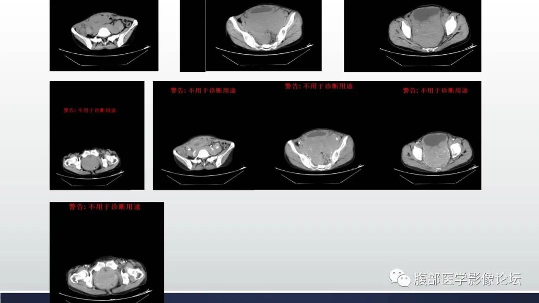 影像PPT - 【病例】子宫内膜样腺癌 VS 子宫内膜炎 MR-4