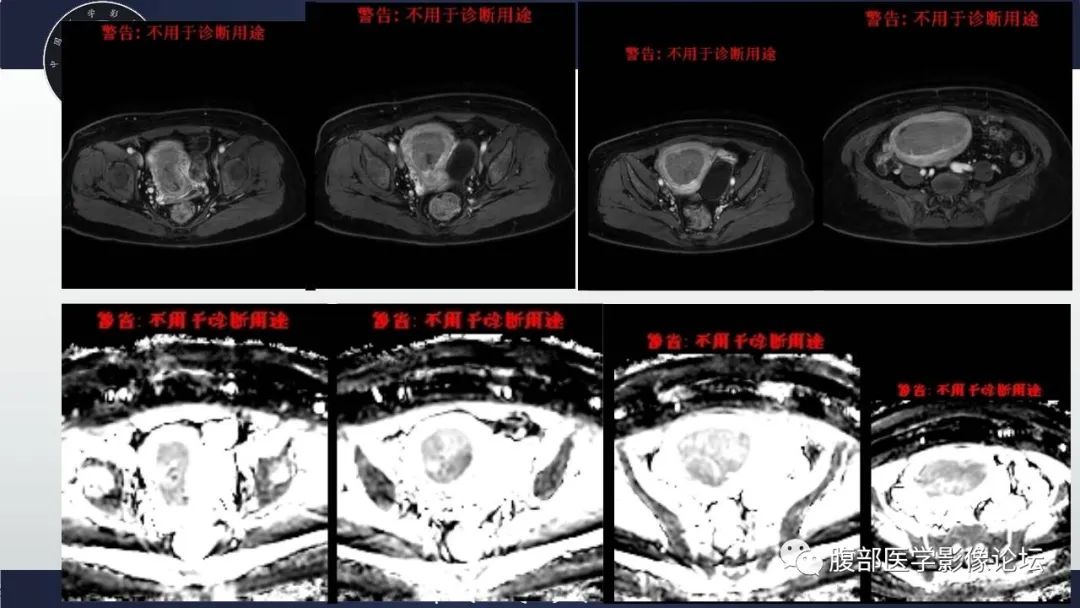 影像PPT - 【病例】子宫内膜样腺癌 VS 子宫内膜炎 MR-8