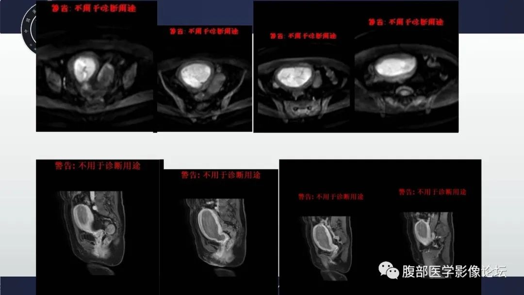 影像PPT - 【病例】子宫内膜样腺癌 VS 子宫内膜炎 MR-9