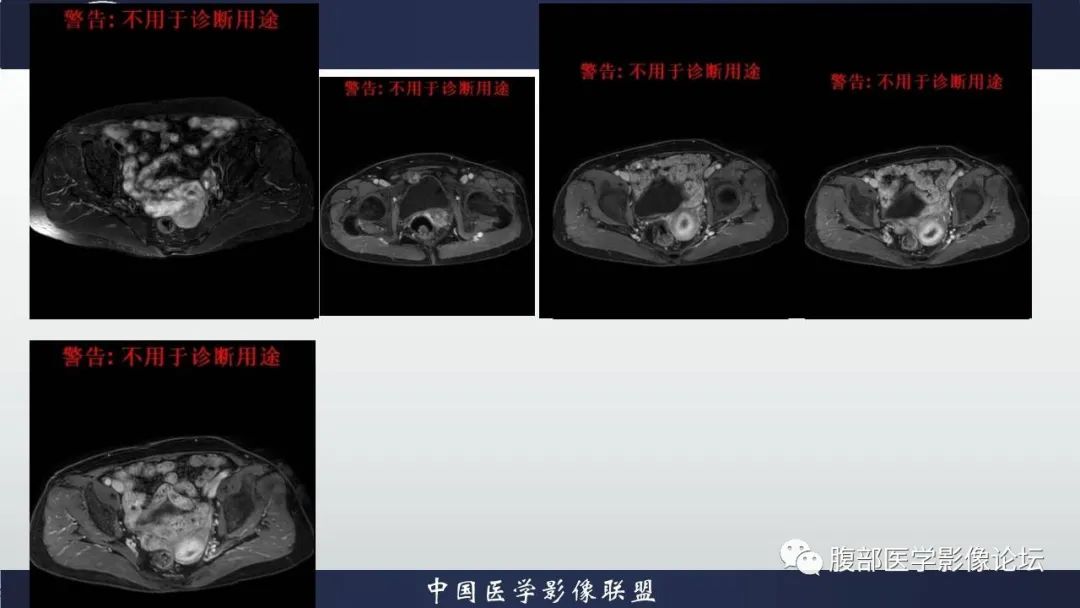 影像PPT - 【病例】子宫内膜样腺癌 VS 子宫内膜炎 MR-12