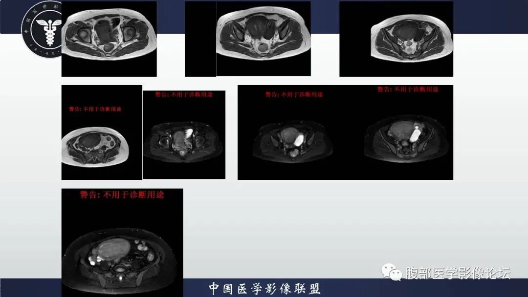 影像PPT - 【病例】子宫内膜样腺癌 VS 子宫内膜炎 MR-7
