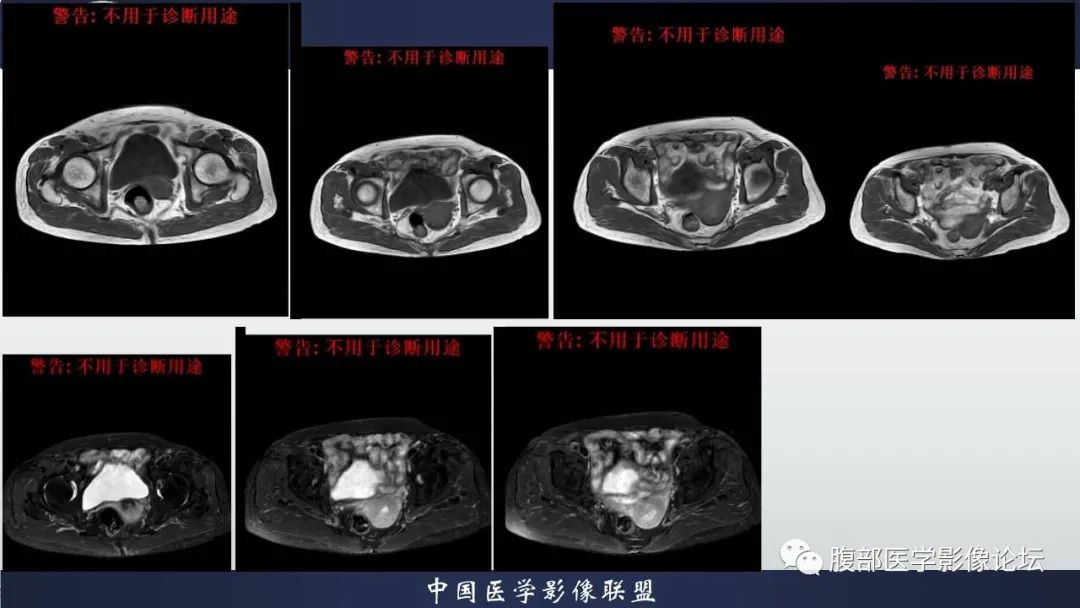 影像PPT - 【病例】子宫内膜样腺癌 VS 子宫内膜炎 MR-11