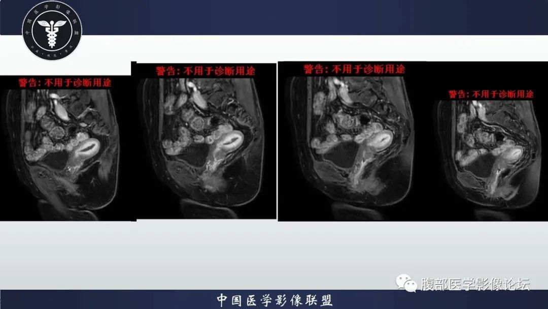 影像PPT - 【病例】子宫内膜样腺癌 VS 子宫内膜炎 MR-13