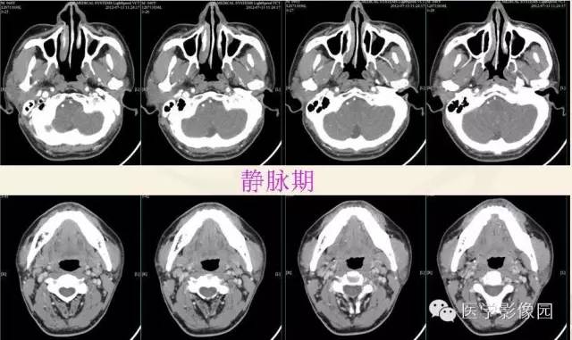 影像PPT - 【病例】腮腺腺泡细胞癌1例CT影像-6