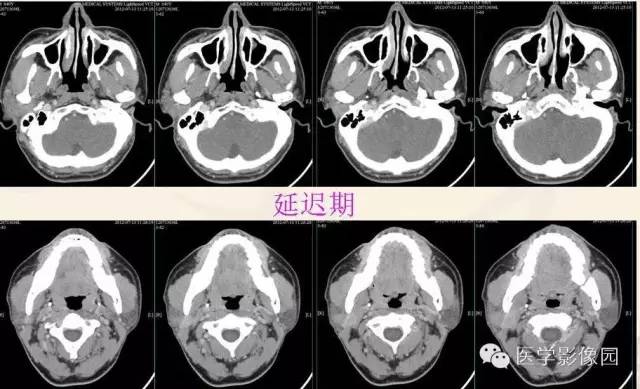 影像PPT - 【病例】腮腺腺泡细胞癌1例CT影像-9