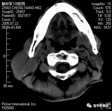 影像PPT - 涎腺腺样囊性癌-1