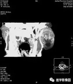 影像PPT - 涎腺腺样囊性癌-4 影像PPT - 涎腺腺样囊性癌-4