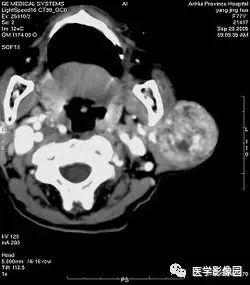 影像PPT - 涎腺腺样囊性癌-3 影像PPT - 涎腺腺样囊性癌-3