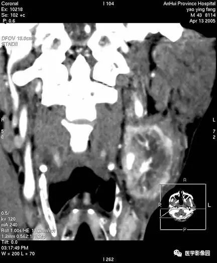 影像PPT - 涎腺腺样囊性癌-6 影像PPT - 涎腺腺样囊性癌-6