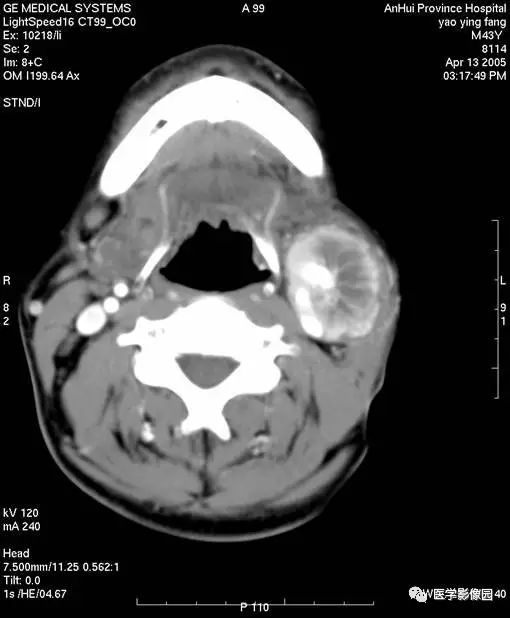 影像PPT - 涎腺腺样囊性癌-5 影像PPT - 涎腺腺样囊性癌-5