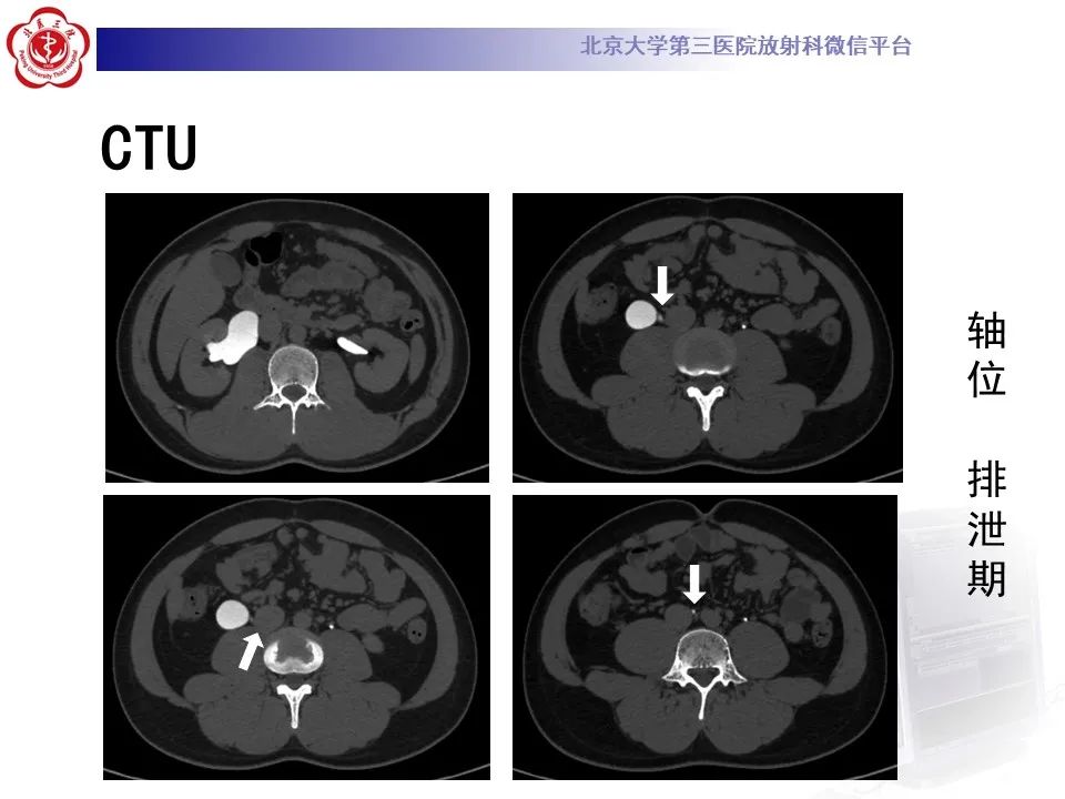 影像PPT - 【PPT】下腔静脉后输尿管的影像-4