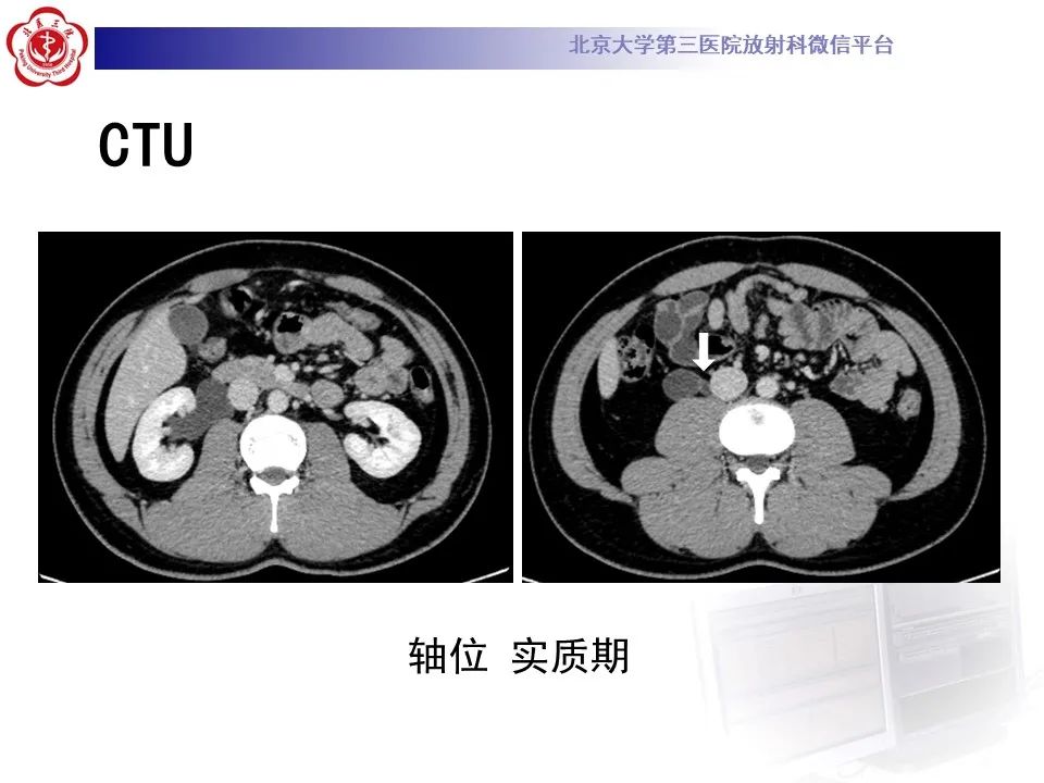 影像PPT - 【PPT】下腔静脉后输尿管的影像-3
