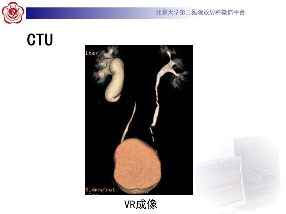 影像PPT - 【PPT】下腔静脉后输尿管的影像-6
