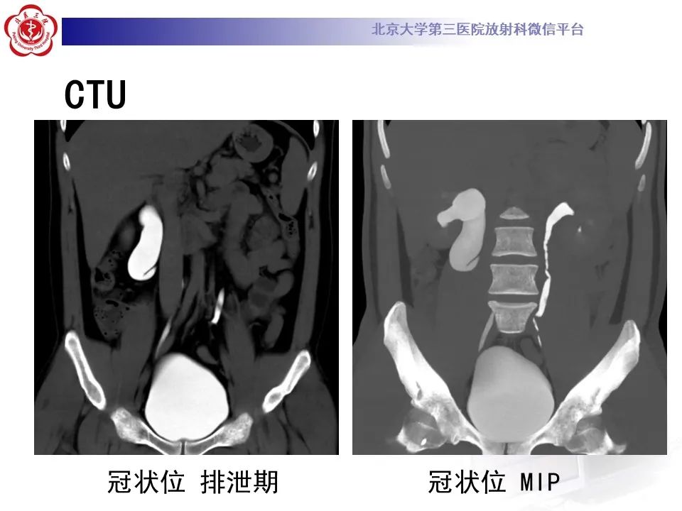 影像PPT - 【PPT】下腔静脉后输尿管的影像-5