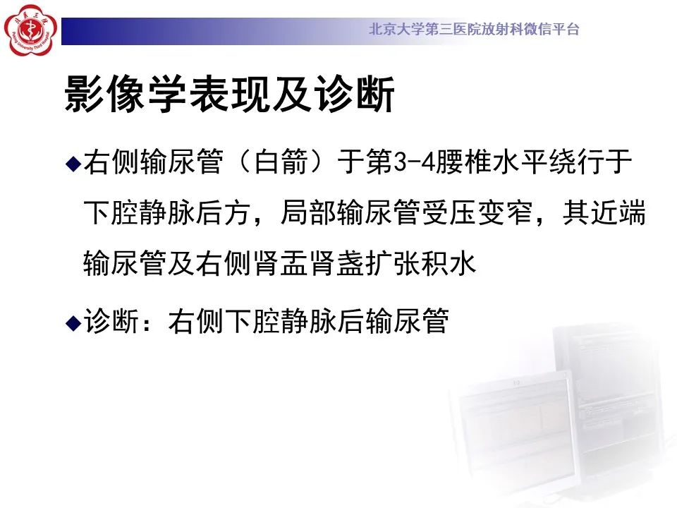 影像PPT - 【PPT】下腔静脉后输尿管的影像-7