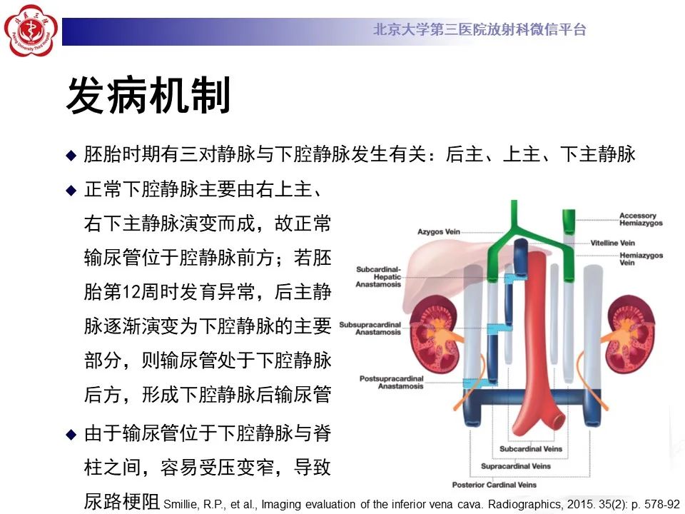 影像PPT - 【PPT】下腔静脉后输尿管的影像-11