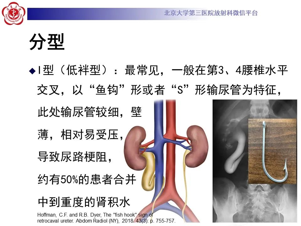 影像PPT - 【PPT】下腔静脉后输尿管的影像-13