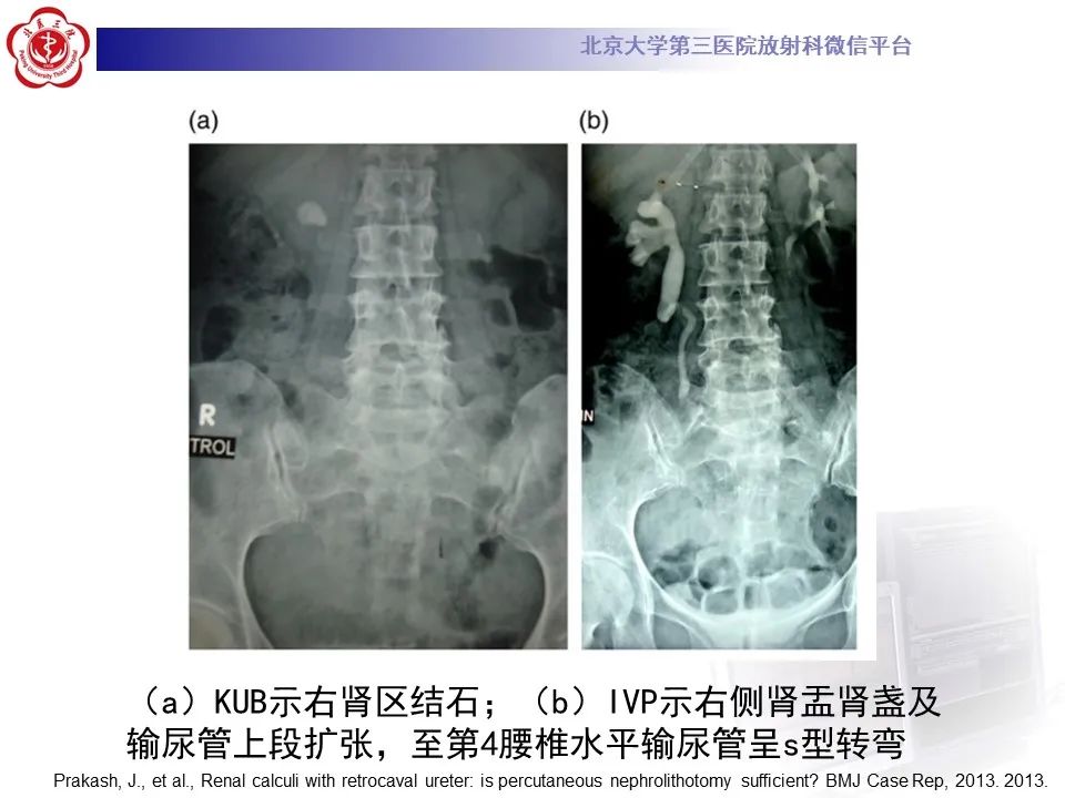 影像PPT - 【PPT】下腔静脉后输尿管的影像-17