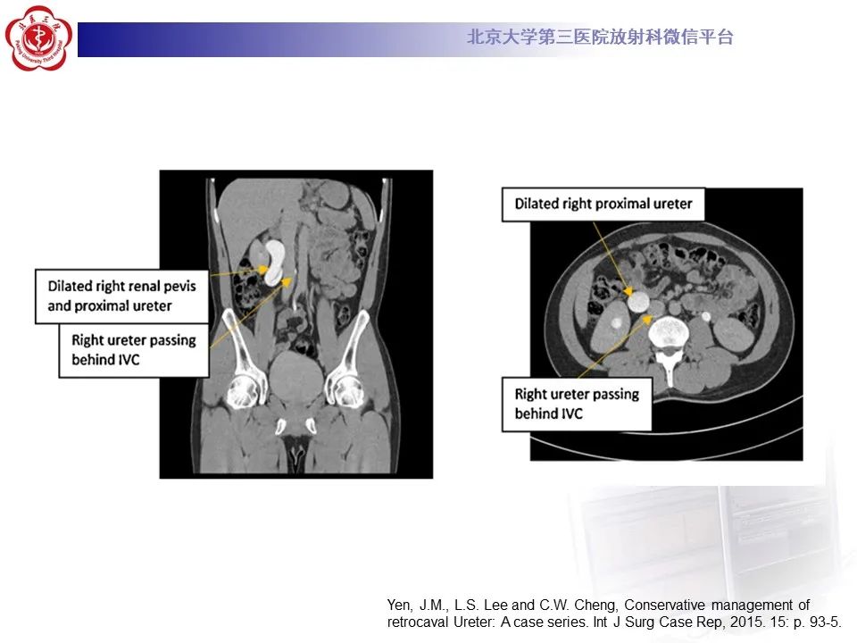影像PPT - 【PPT】下腔静脉后输尿管的影像-19