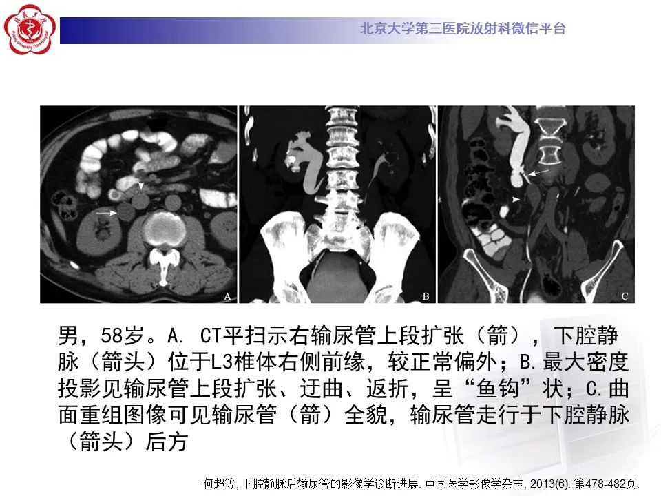 影像PPT - 【PPT】下腔静脉后输尿管的影像-20