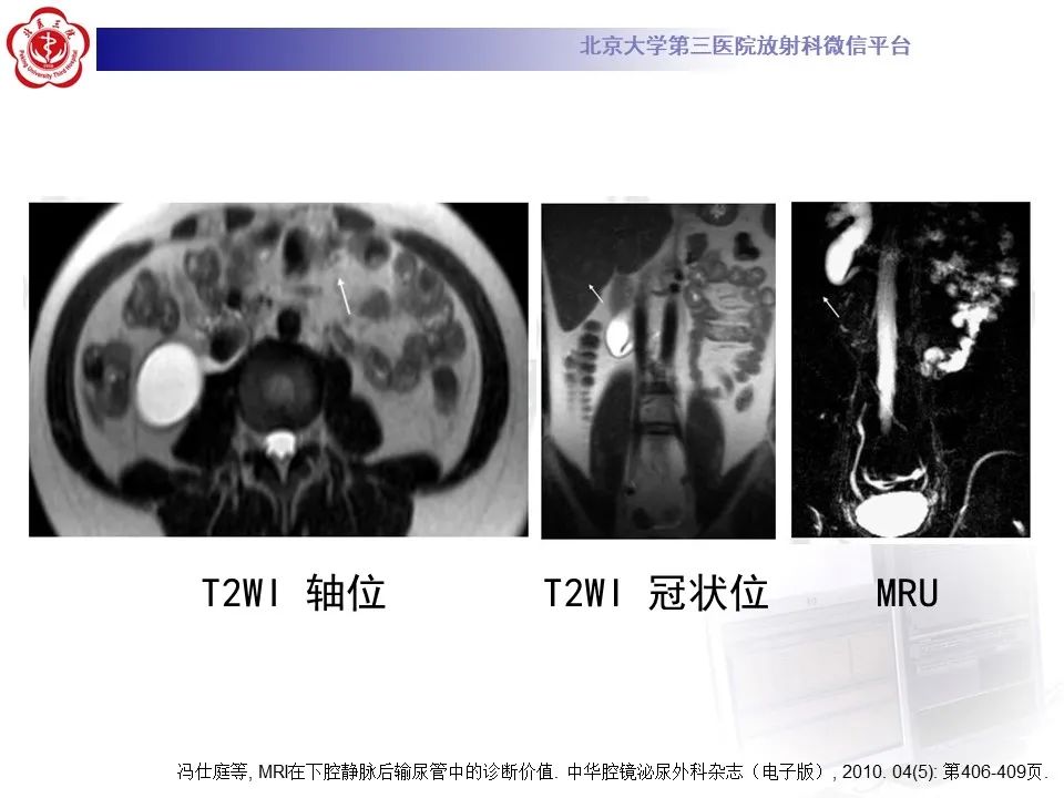 影像PPT - 【PPT】下腔静脉后输尿管的影像-21
