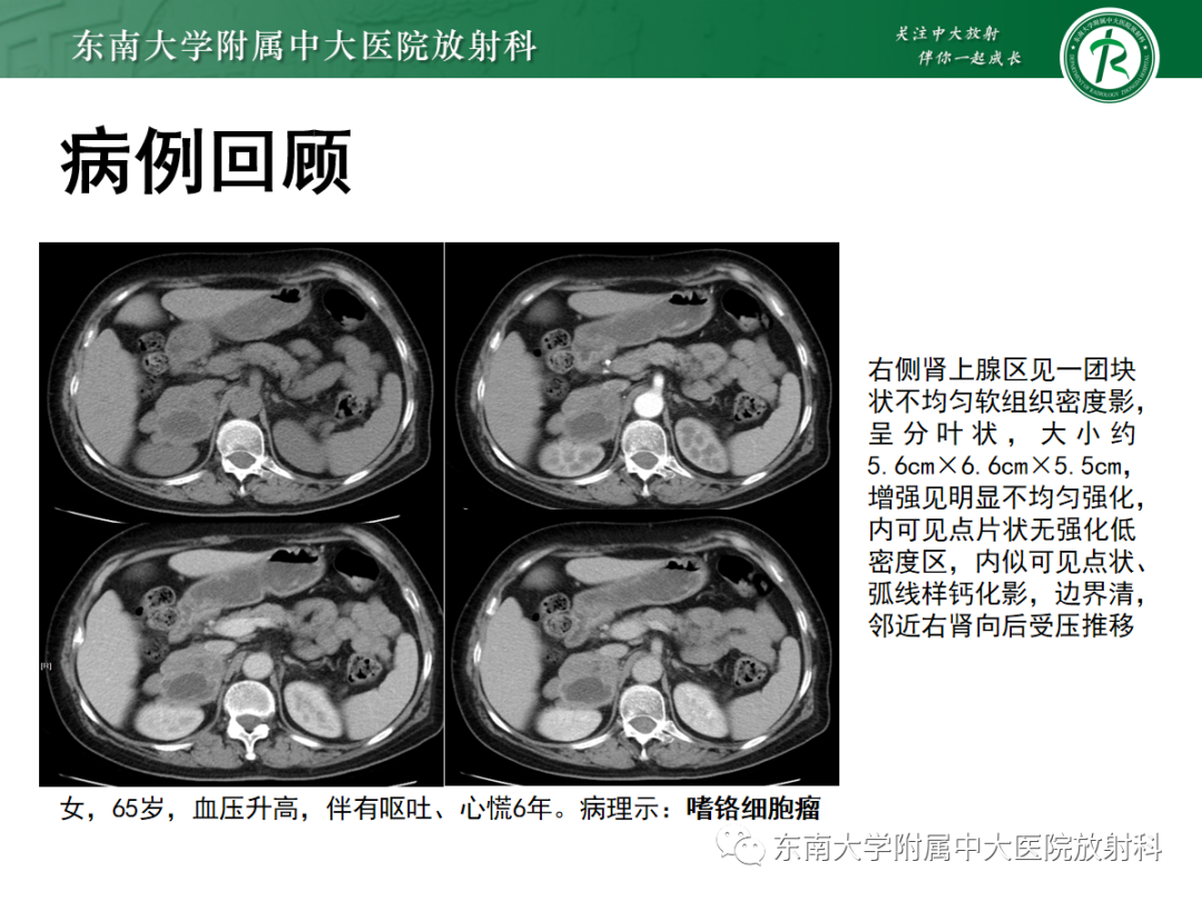 影像PPT - 【PPT】肾上腺占位性病变-2