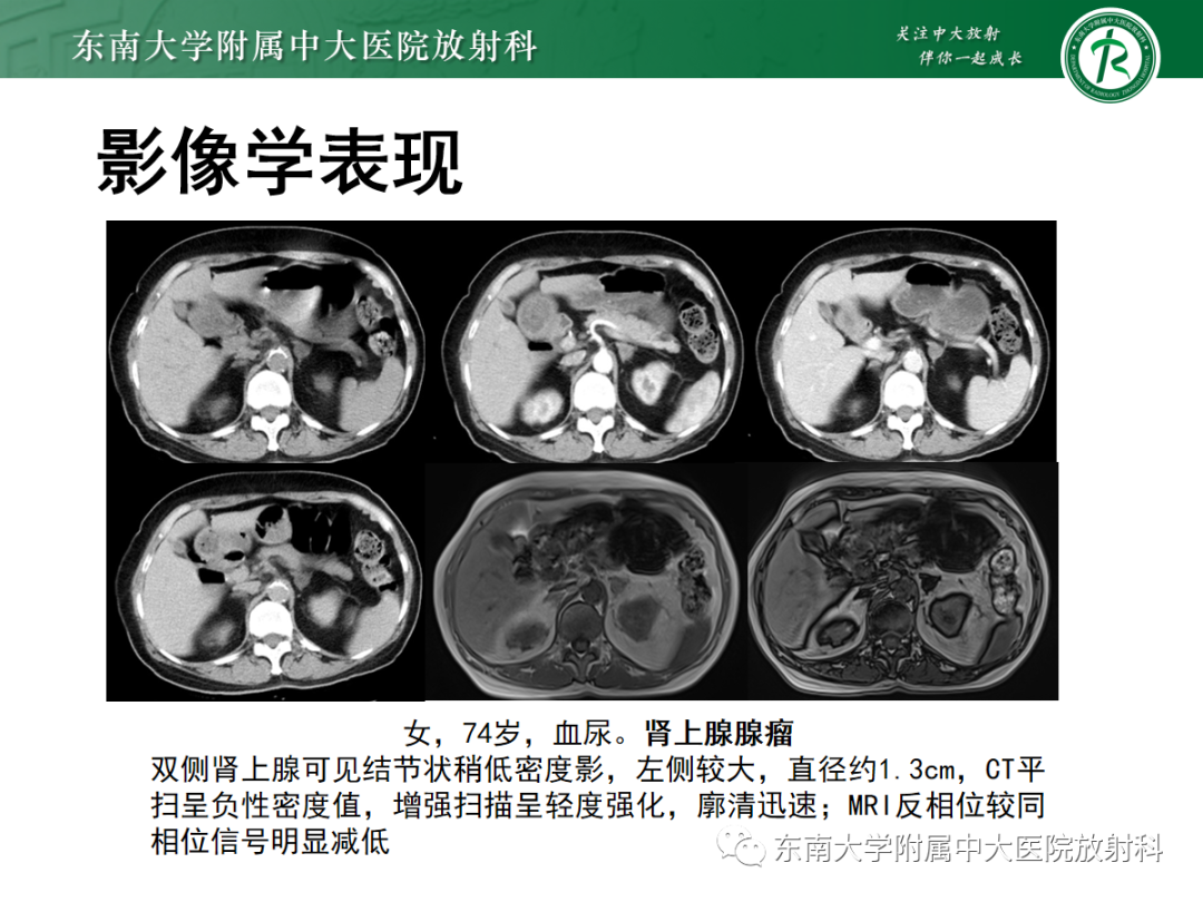 影像PPT - 【PPT】肾上腺占位性病变-7