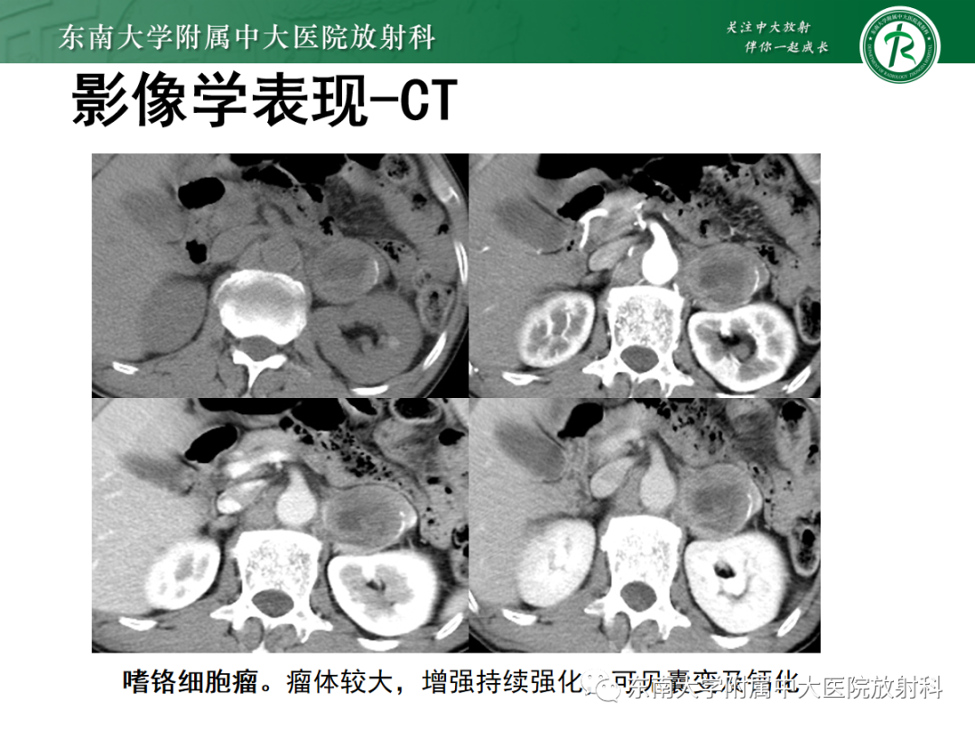 影像PPT - 【PPT】肾上腺占位性病变-12