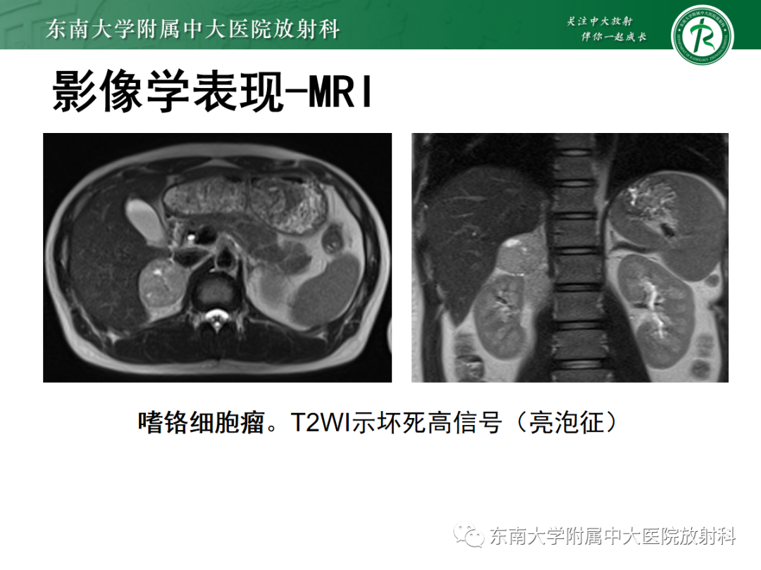 影像PPT - 【PPT】肾上腺占位性病变-13