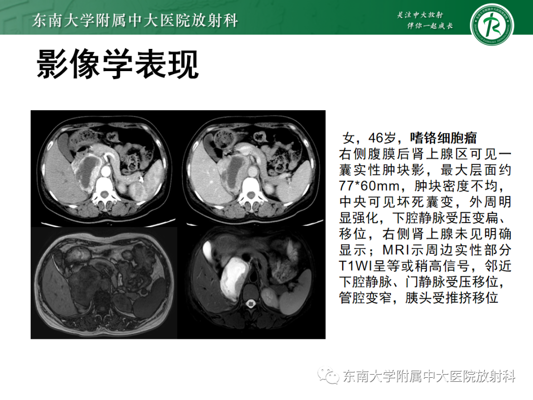 影像PPT - 【PPT】肾上腺占位性病变-14