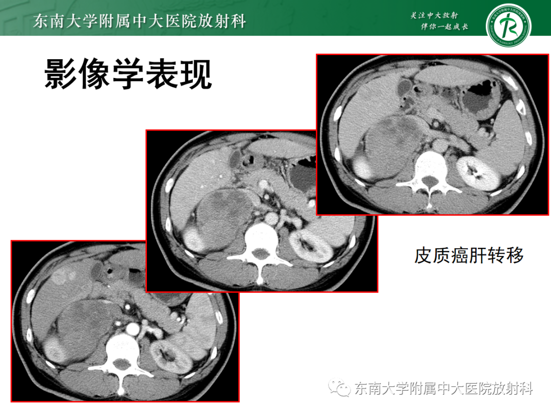 影像PPT - 【PPT】肾上腺占位性病变-19