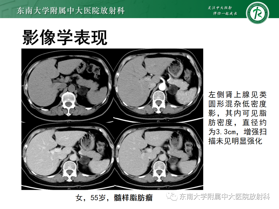 影像PPT - 【PPT】肾上腺占位性病变-22