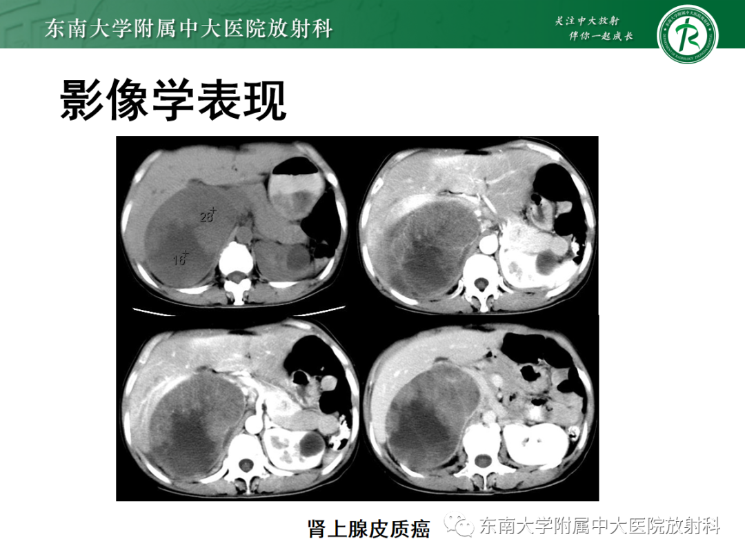 影像PPT - 【PPT】肾上腺占位性病变-18