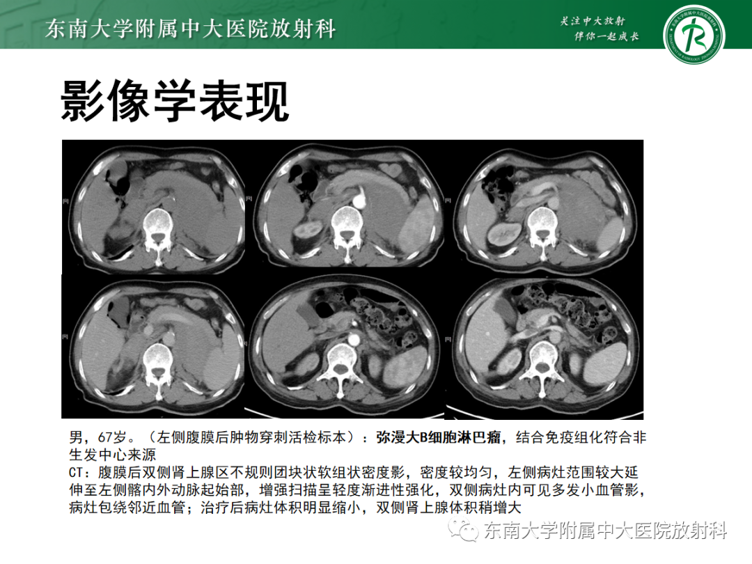影像PPT - 【PPT】肾上腺占位性病变-25