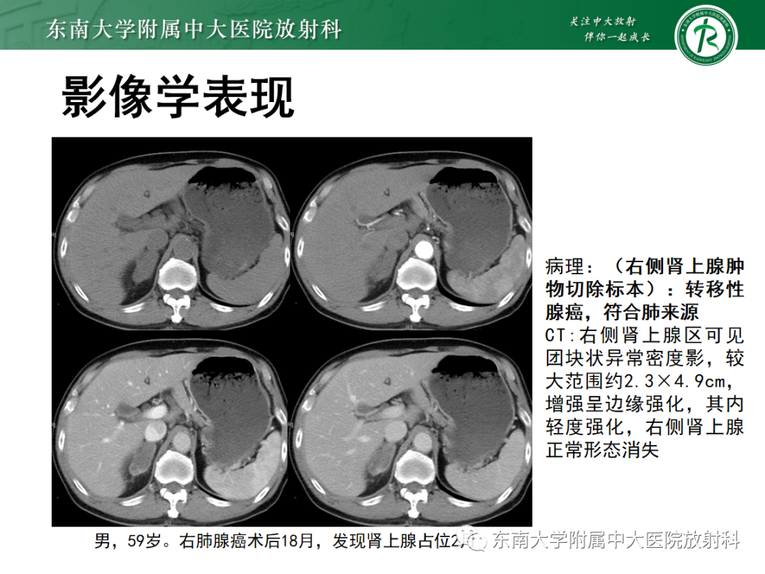 影像PPT - 【PPT】肾上腺占位性病变-28