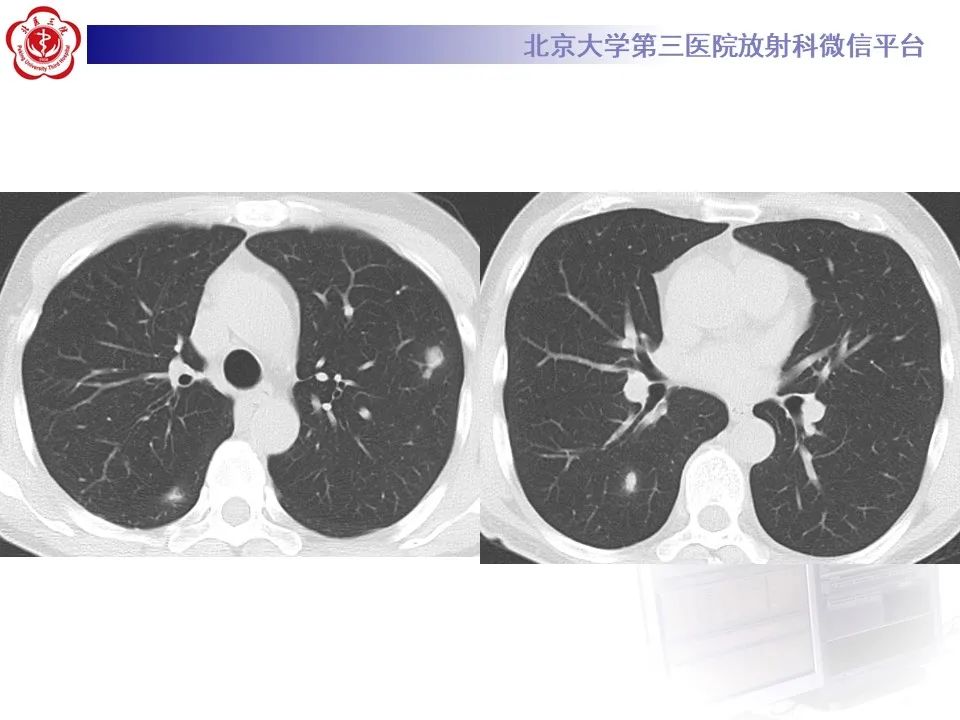影像PPT - 【PPT】肺隐球菌病的影像-5